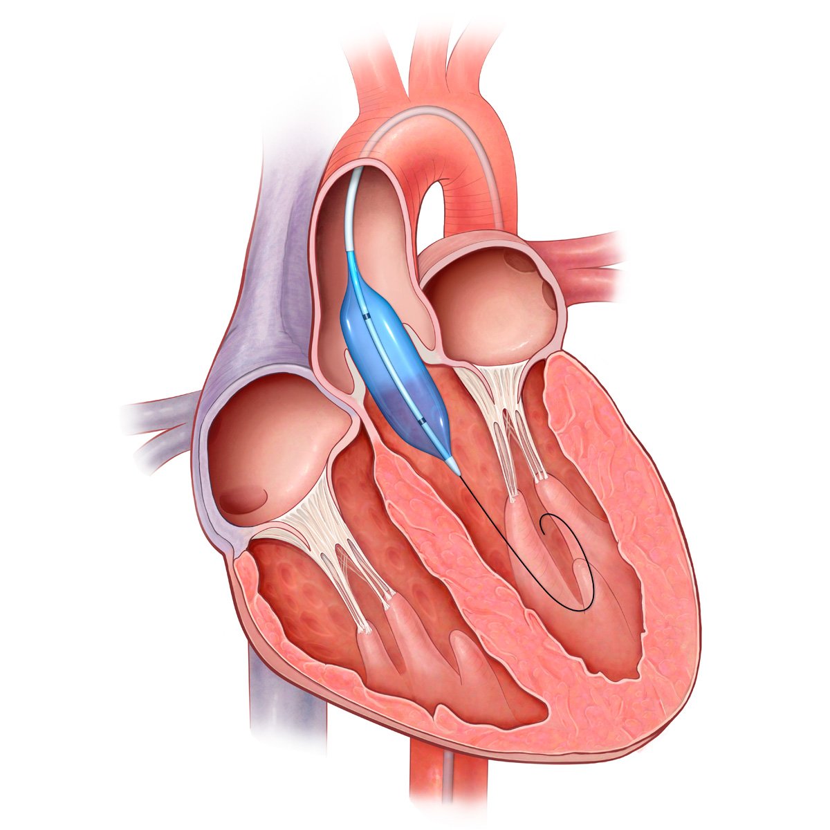 Митральный клапан после операции. Аортальный клапан сердца. Митральный и аортальный клапан сердца. Митральный клапан и аортальный клапан.