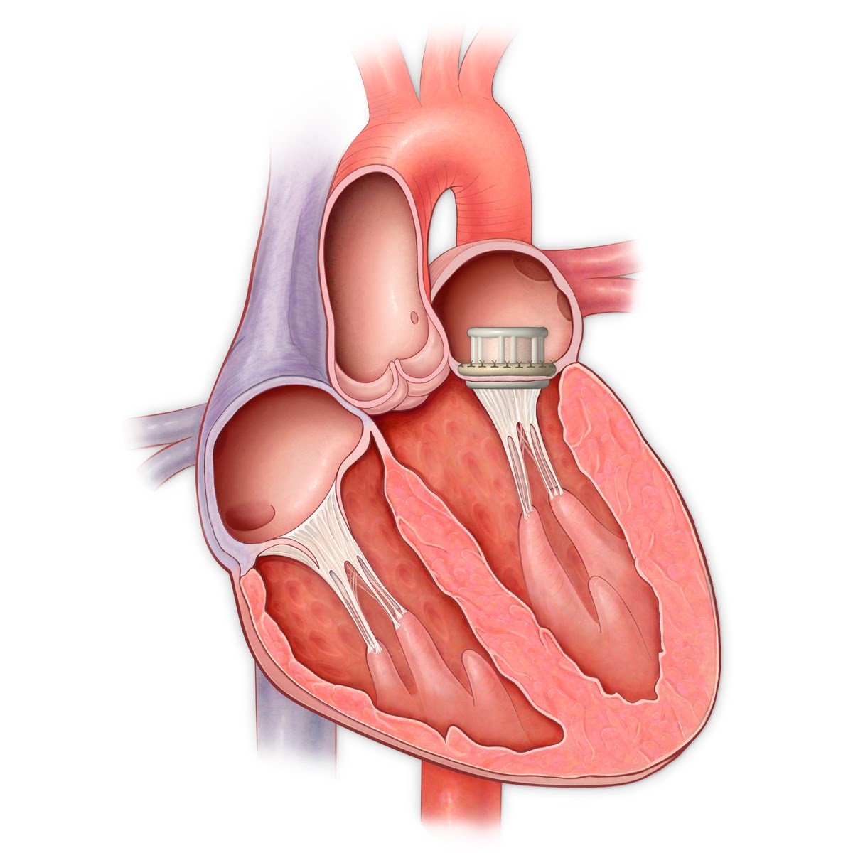 Недостаточность предсердия. Ммтральный клапан сердце. Митральный клапан сердца. Митральный и аортальный клапан. Митральный клапан и аортальный клапан.