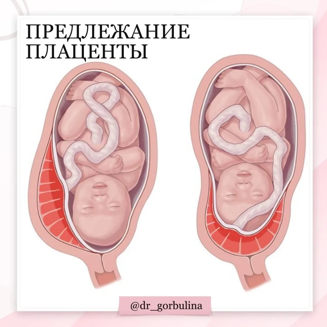 Низкая плацента. Предлежание плаценты. Типы расположения плаценты. Прикрепление плаценты. Плацента по передней стенке.